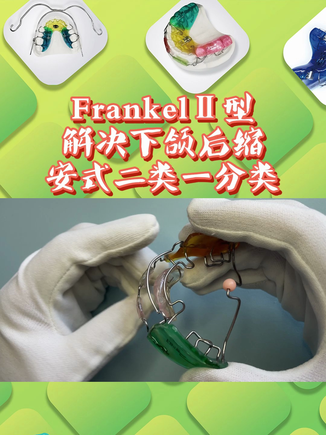 替牙期儿童下颌后缩能用的矫治器 frankel Ⅱ型矫治器 妃她正畸