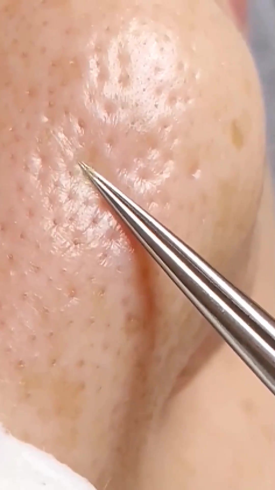 手挤痘痘黑头易造成皮肤损伤,好的护肤是3分清洁7分护理的