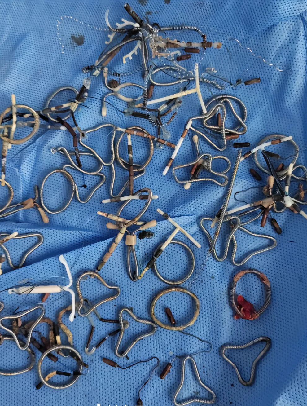 多少被遗忘在体内的节育环,快问问妈妈取出来了没有?