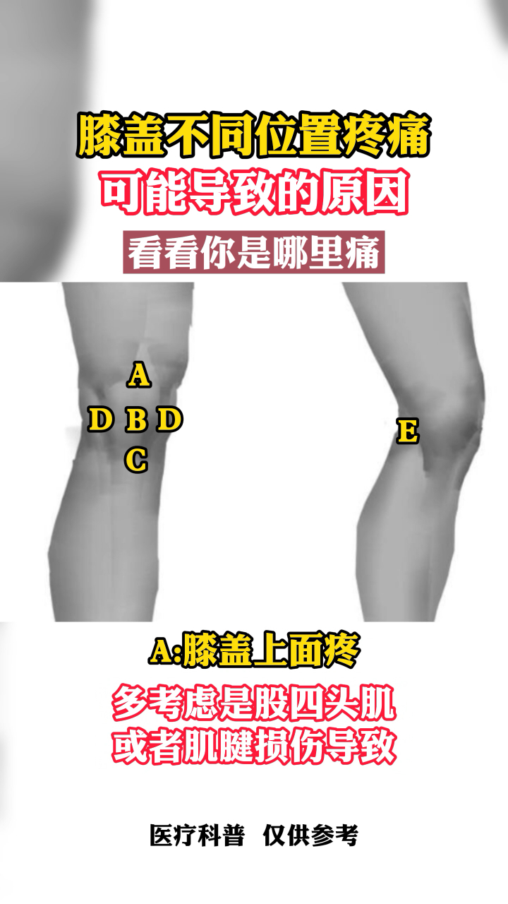 膝盖不同位置疼痛可能导致的原因看看你是哪里痛