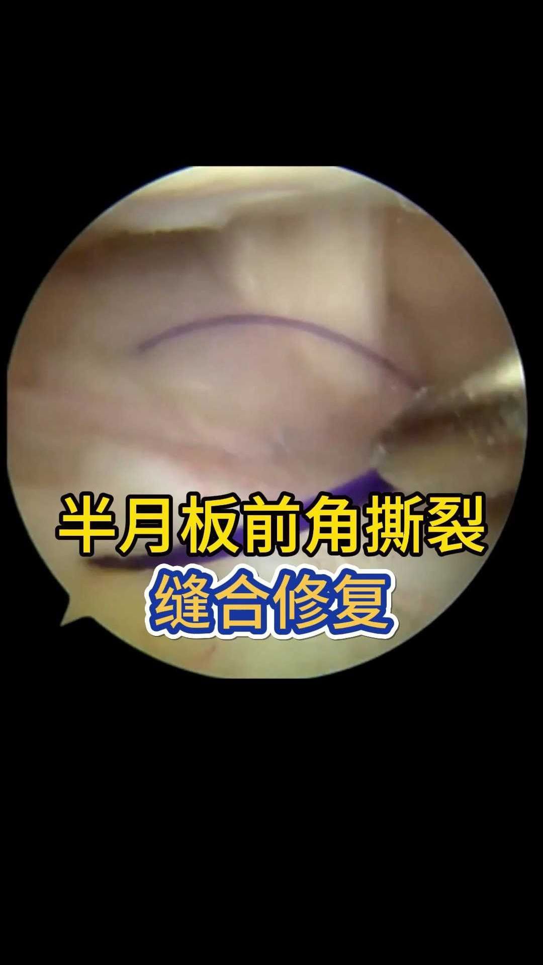 半月板前角撕裂,关节镜下缝合修复