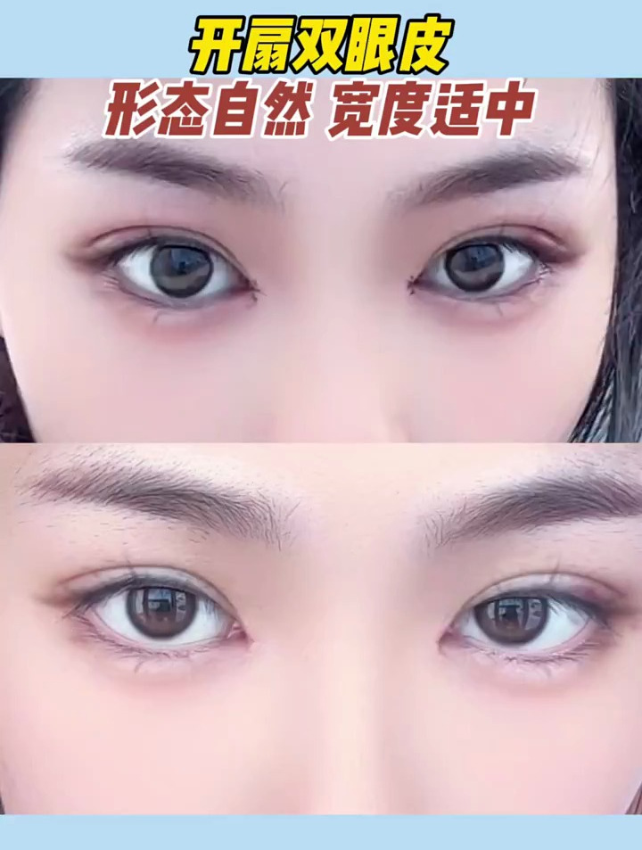 开扇双眼皮形态自然,宽度适中