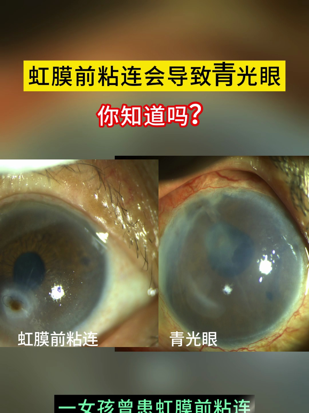 痛心!虹膜前粘连导致青光眼