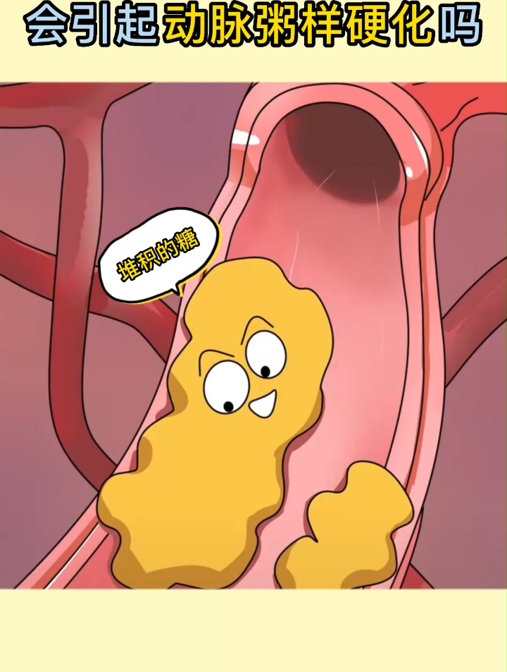 长期吃糖会引起动脉粥样硬化吗