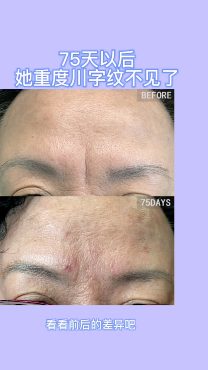 重度川字纹术后75天你能看见疤痕吗
