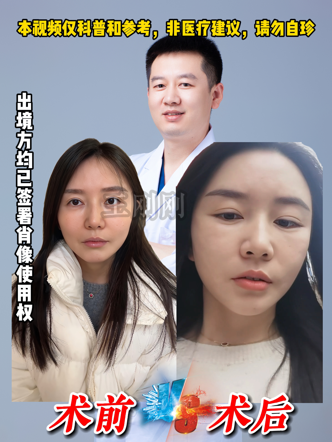 拉皮前两个月后对比