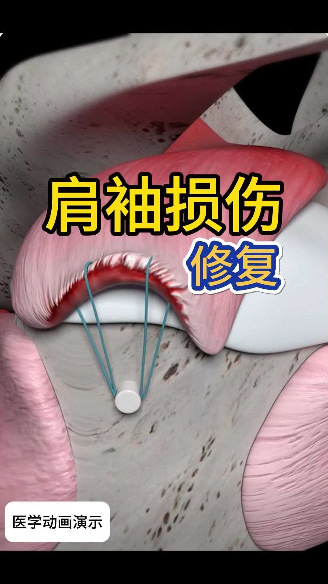 肩袖损伤怎么修复?
