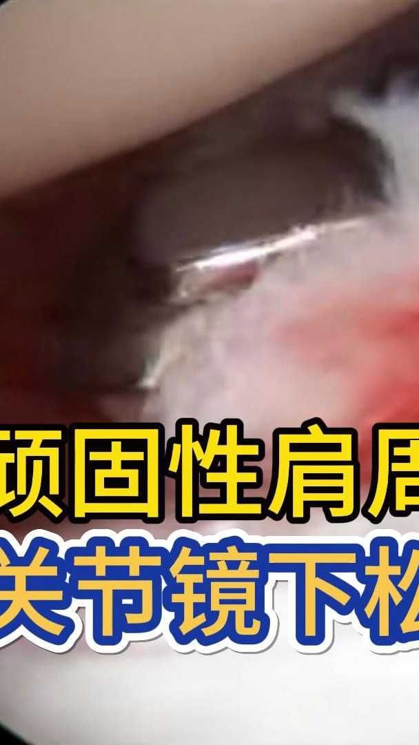 顽固性肩周炎粘连