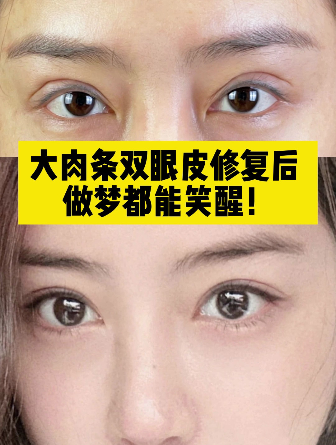 10年肉条感双眼皮修复,真的太自然了!双眼皮修复