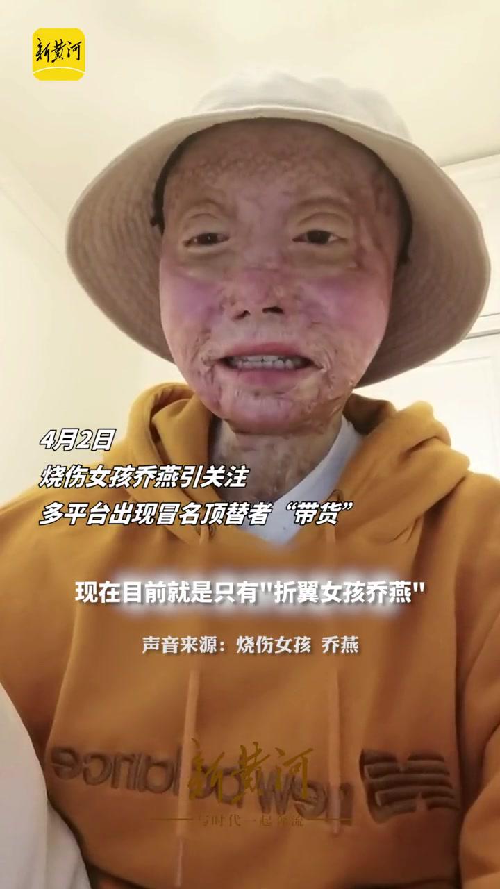 4月2日烧伤女孩乔燕引关注多平台出现冒名顶替者带货