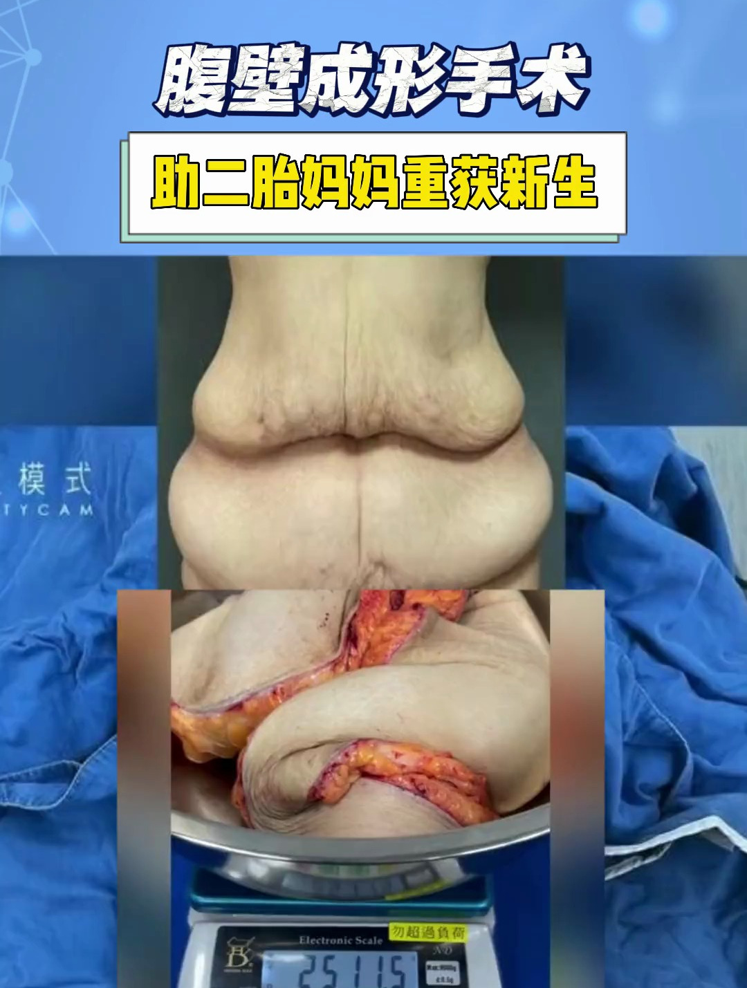 腹部拉皮的恢复图片图片