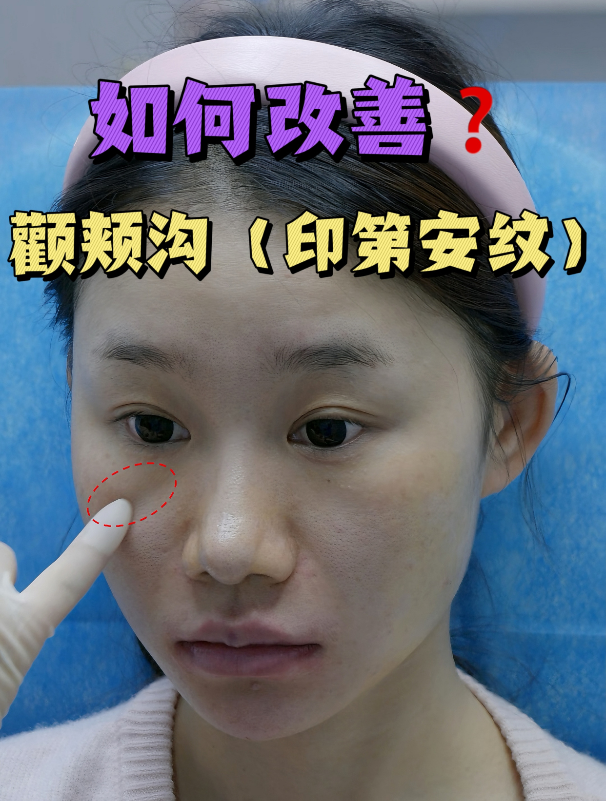 如何改善颧颊沟(印第安纹)?