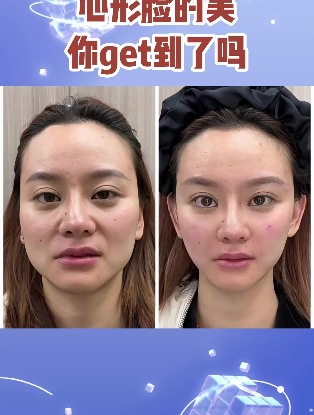 smas筋膜悬吊提升,心形脸的美,你get到了吗