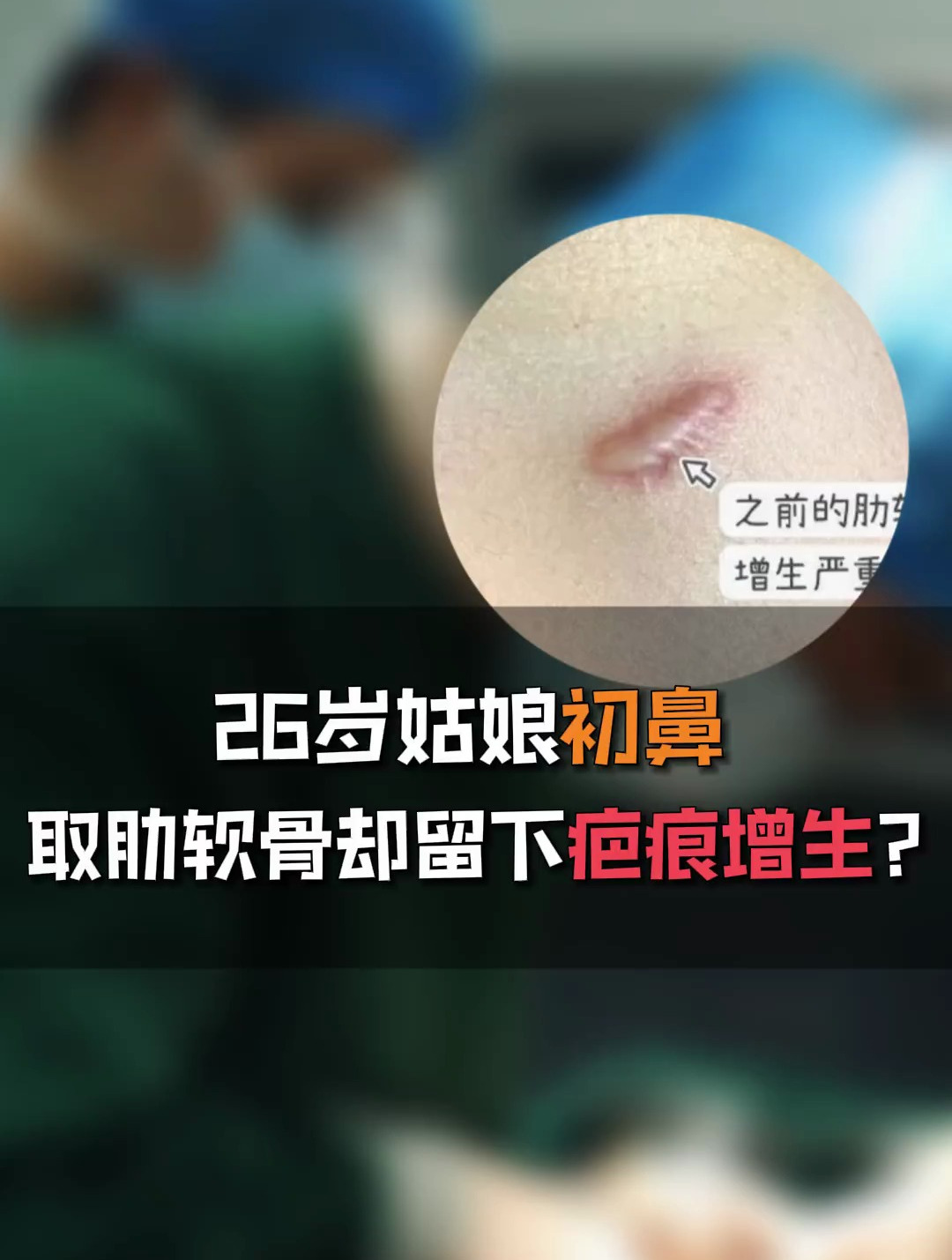 取肋软骨隆鼻,术后留下凸起来变硬的疤痕?只因术前3点没做到位