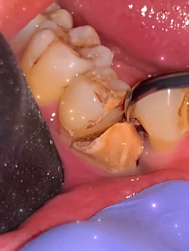 牙疼不是病疼起来真要命,牙结石已经腐蚀到牙齿了,看着就难受-度小视