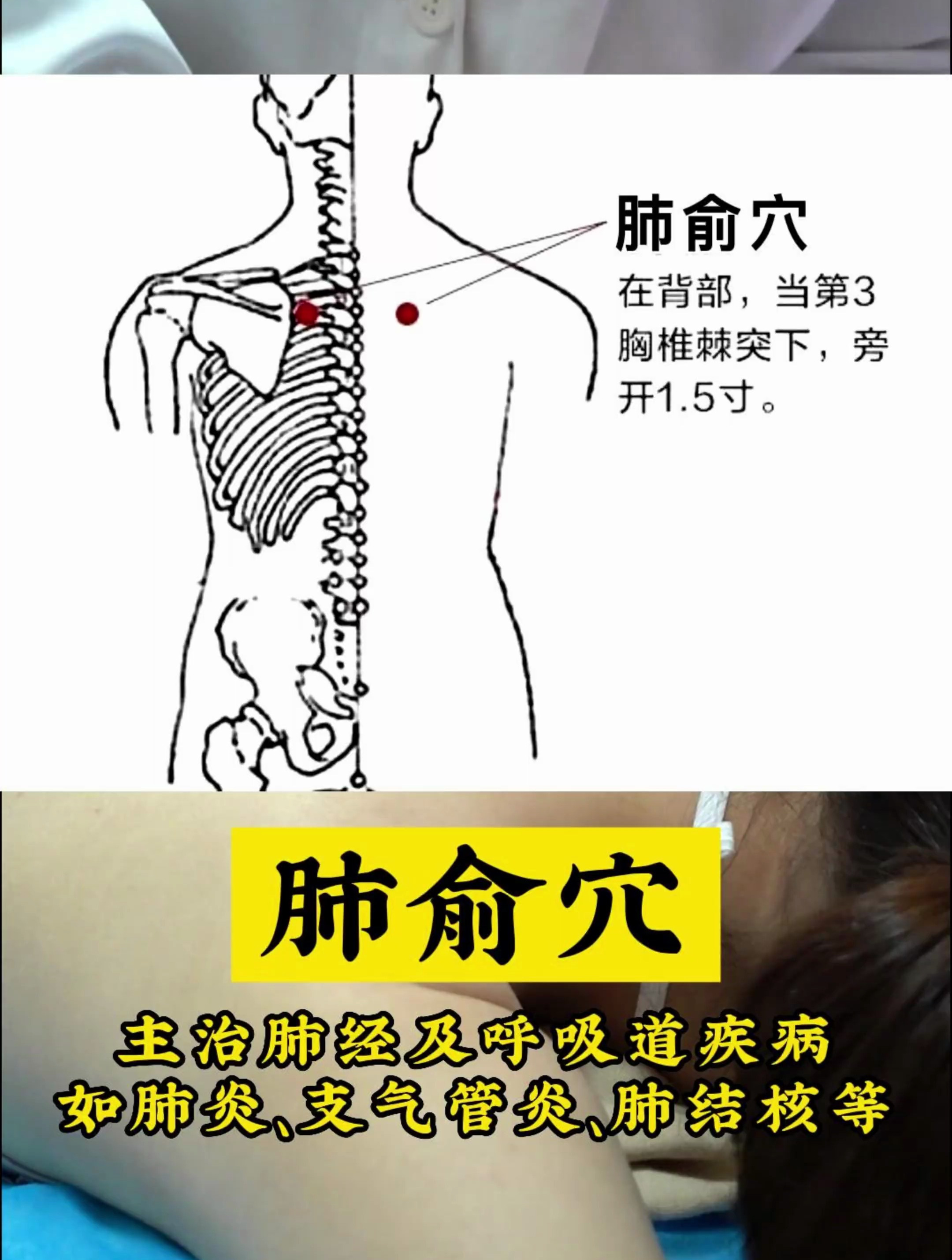 肺俞穴,主治肺经及呼吸道疾病,如肺炎,支气管炎,肺结核等疾病-度小视