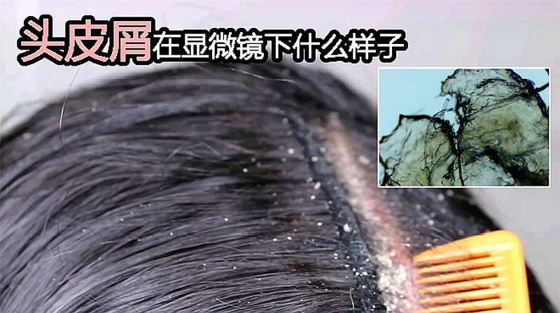 你“发如雪”~头皮屑在显微镜下什么样子?好像还有点壮观,科学,科普,好看视频
