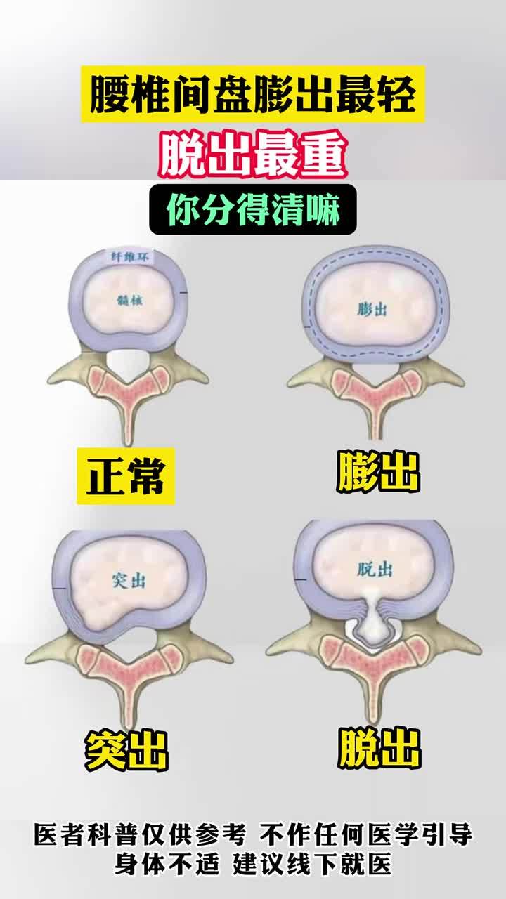 腰椎间盘膨出最轻 脱出最重 你分得清嘛