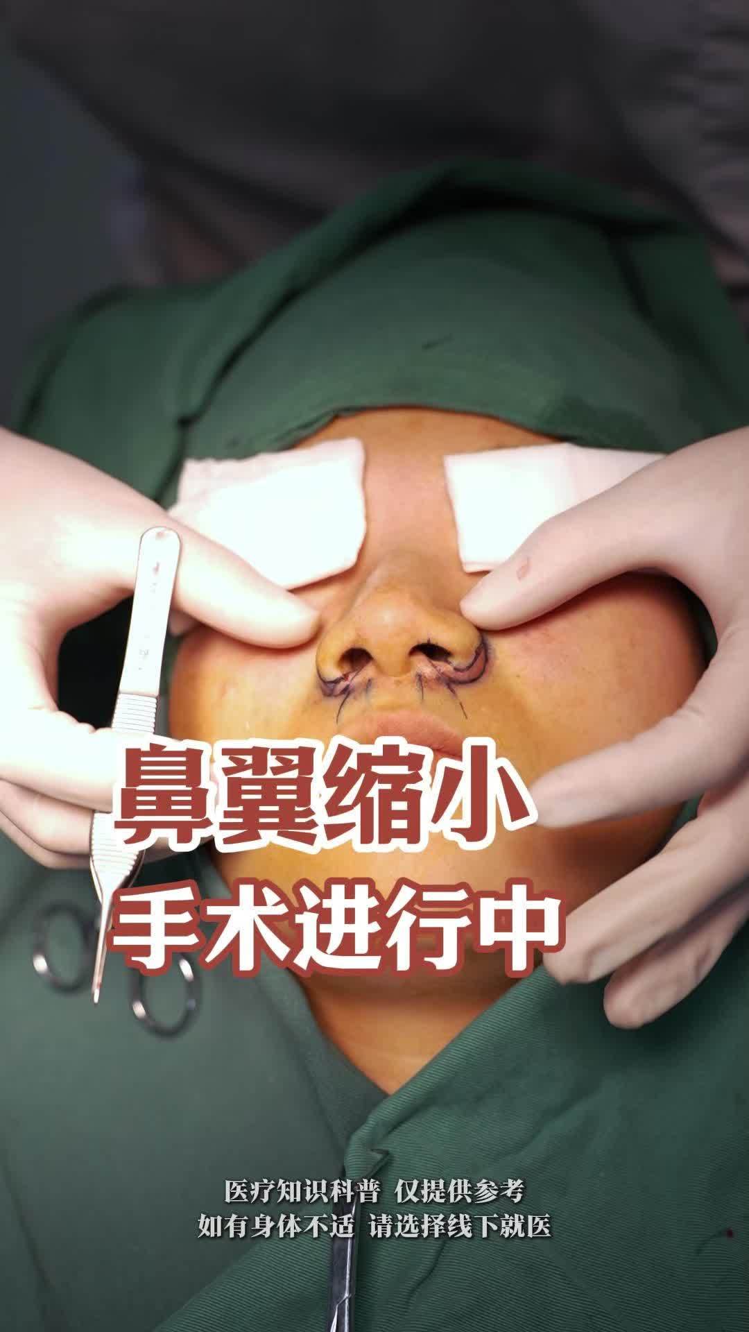 鼻翼缩小手术进行中