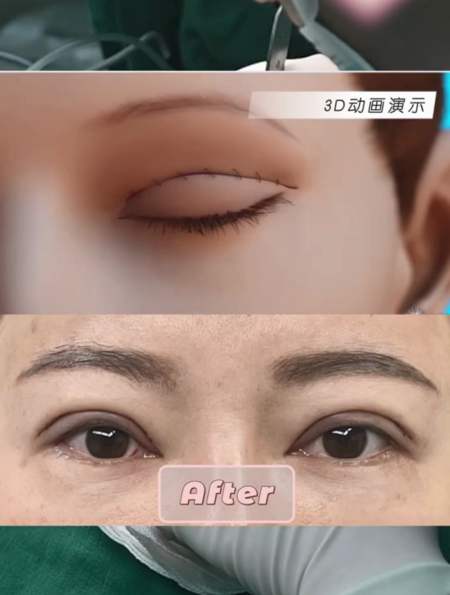 全切双眼皮术后即刻对比照!-度小视