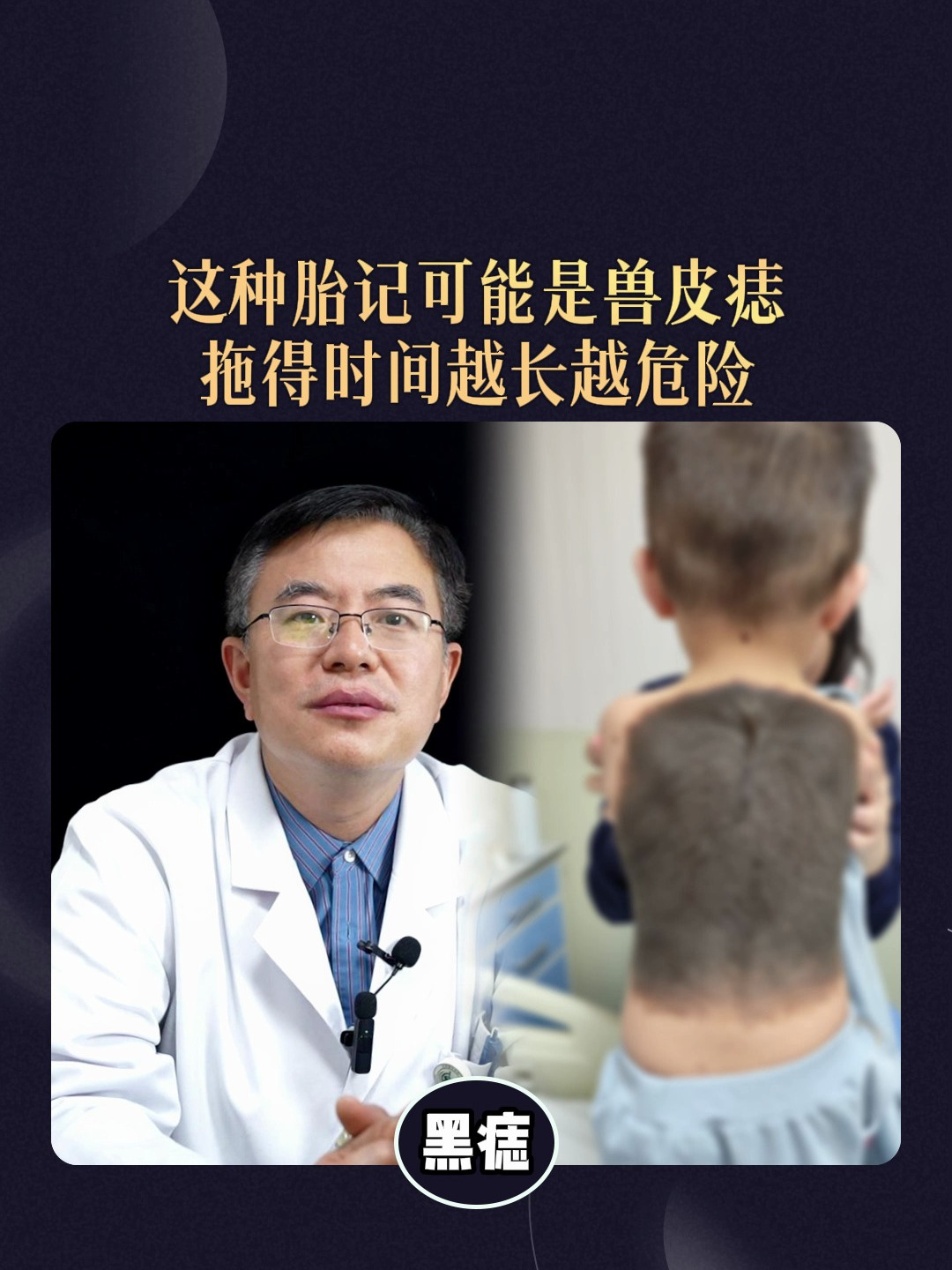 这种胎记可能是兽皮痣,拖得时间越长越危险