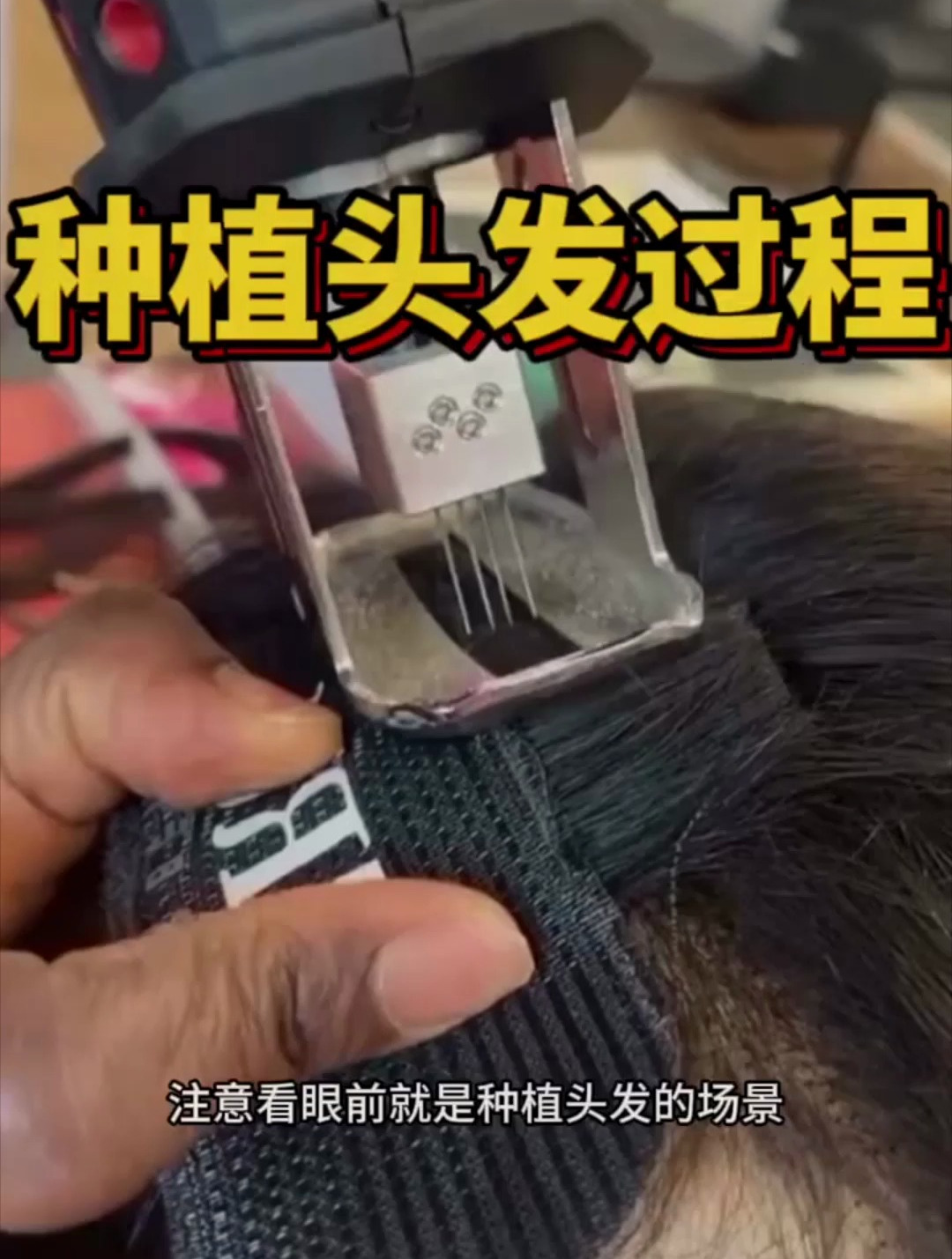 种植头发过程