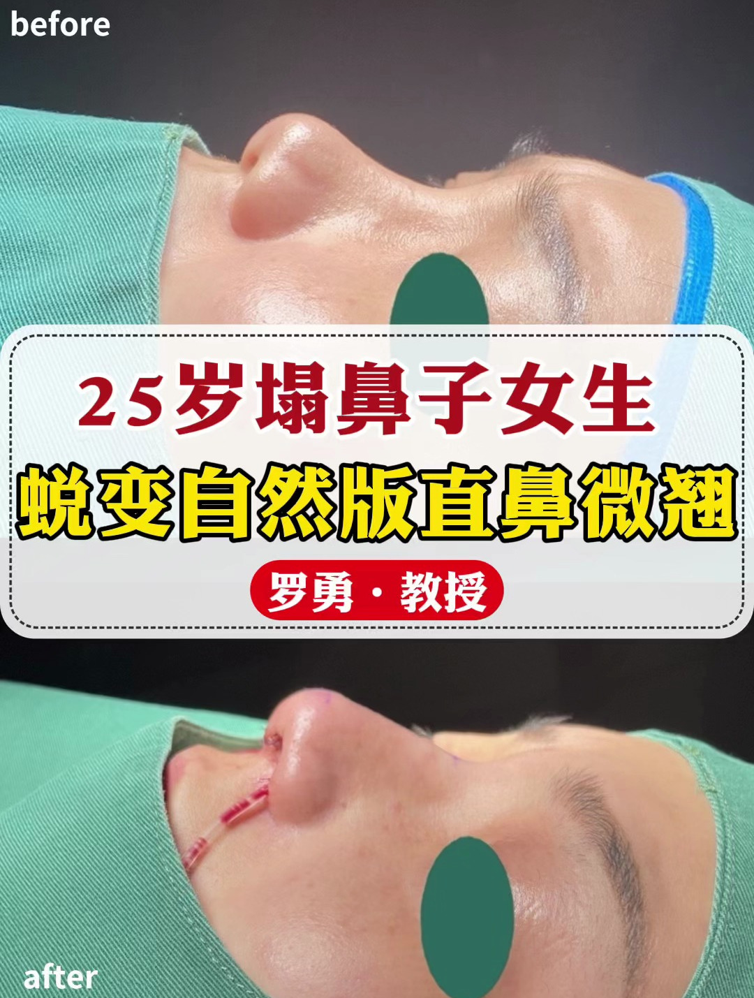 25岁塌鼻子女生成功蜕变自然版直鼻微翘