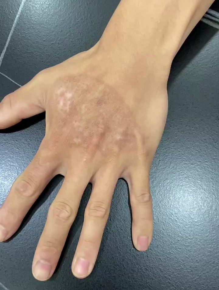手背上有大片烧烫伤疤,还有色素脱失,还有救吗?