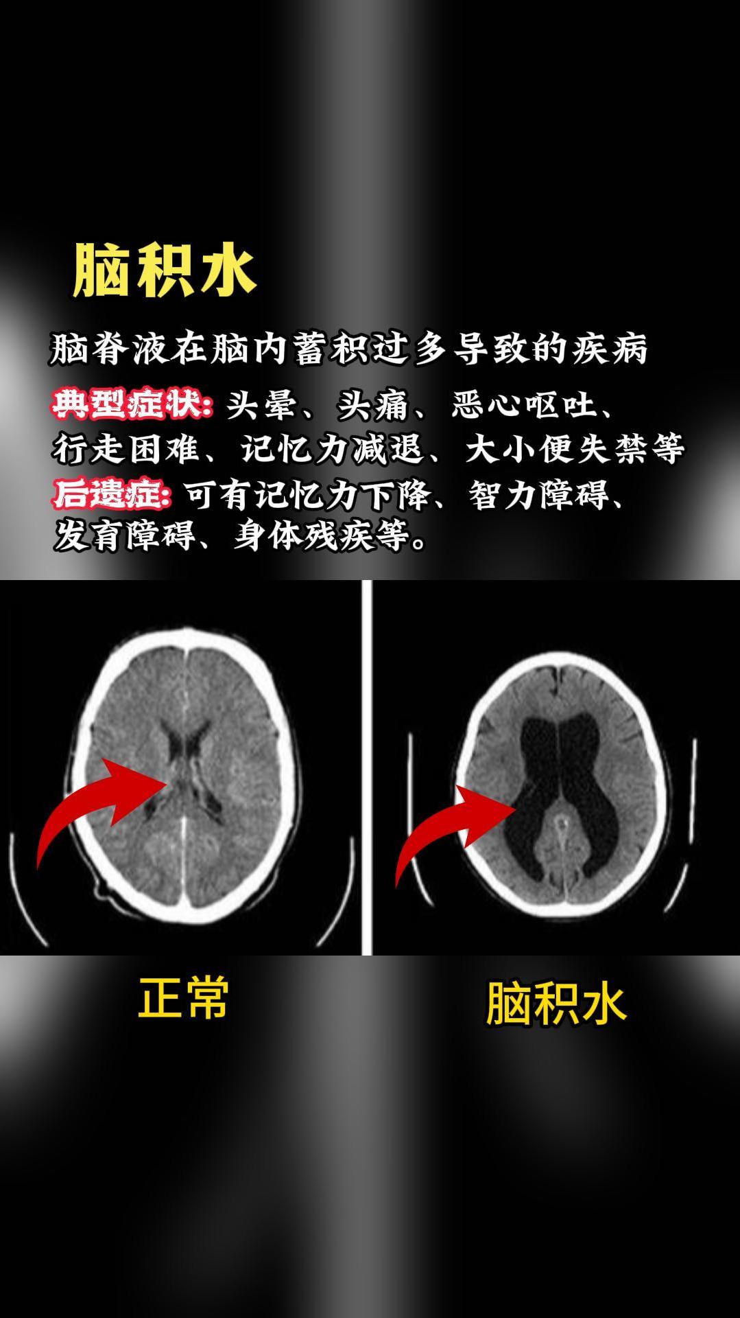 脑积水后遗症图片