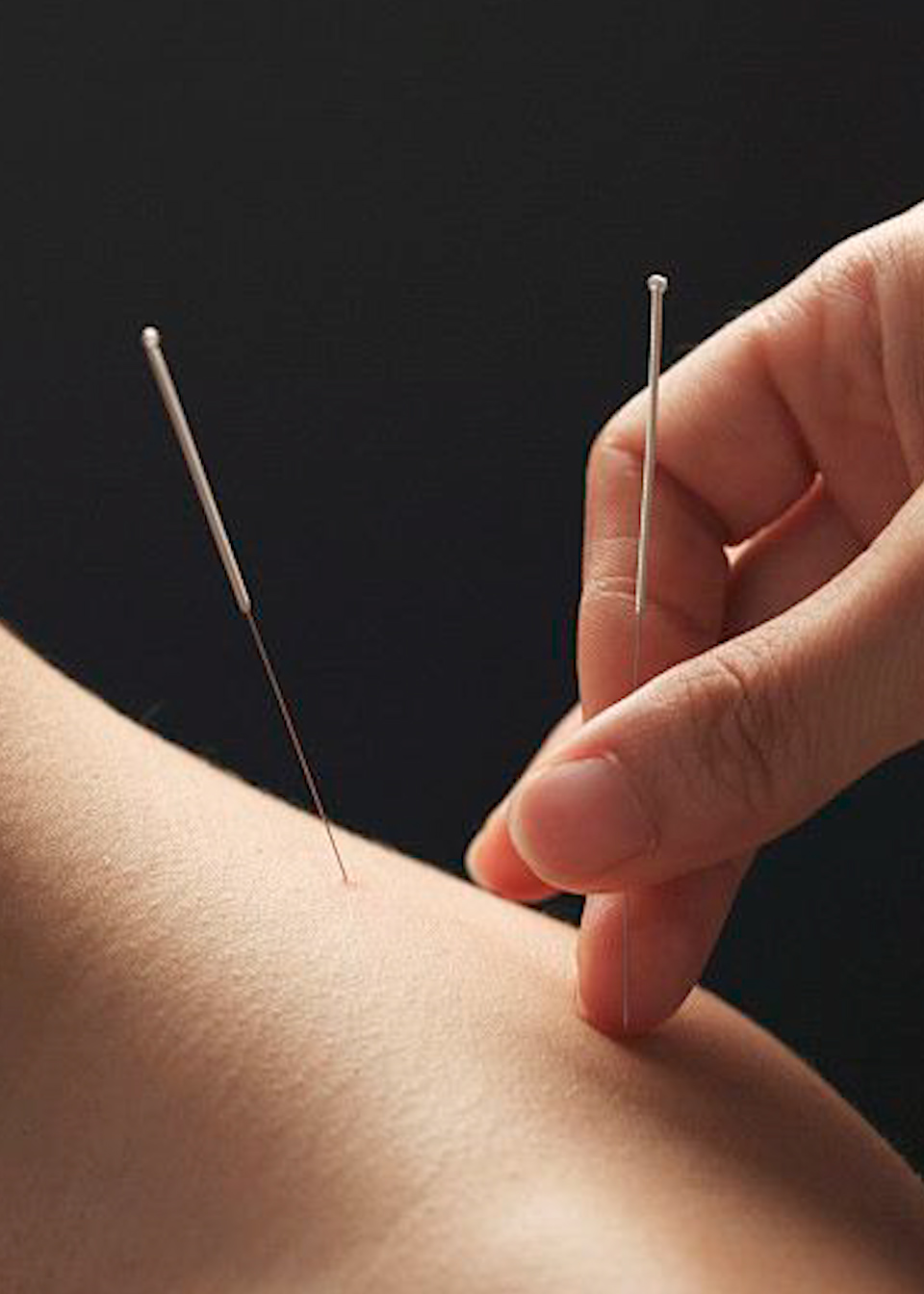 河南首例运用针灸治疗的新冠肺炎患者痊愈出院