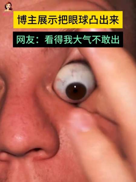 男子展示独家绝活可以把眼球凸出来网友看得我大气不敢出