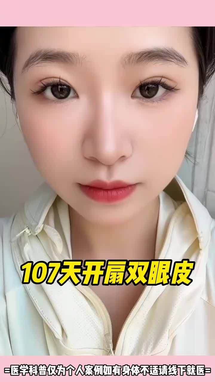 107天开扇形双眼皮反馈