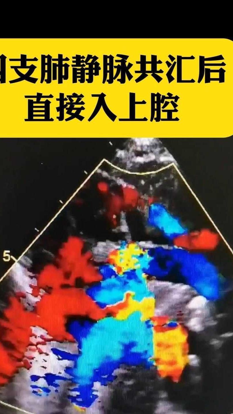 完全性肺静脉异位引流超声
