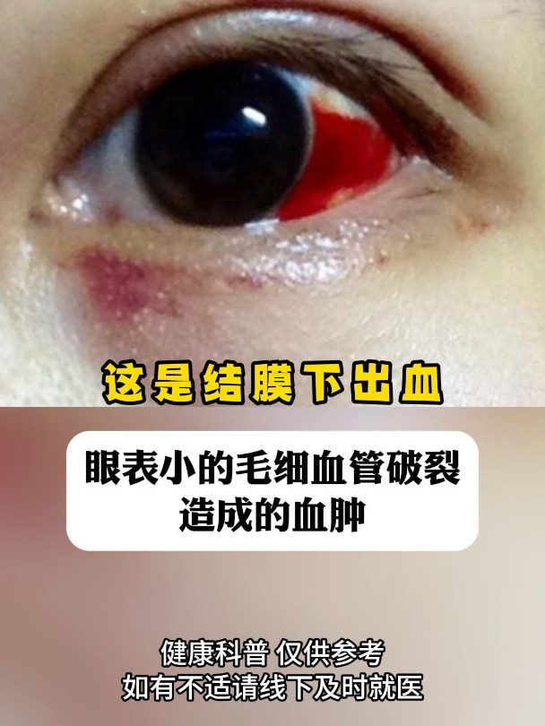 结膜下出血!