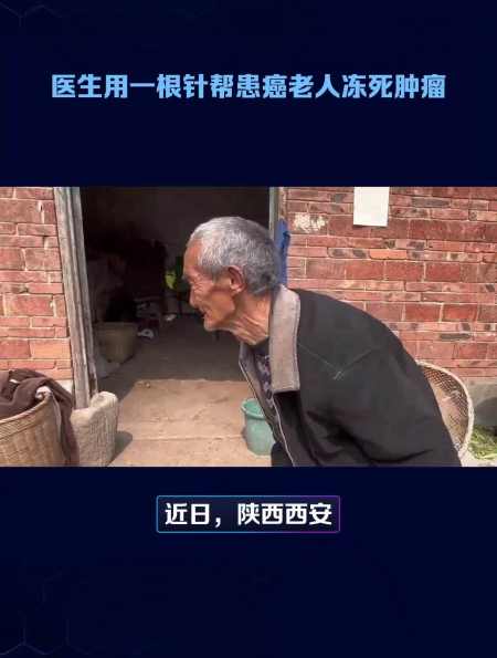 医生用一根针帮患癌老人冻死肿瘤-度小视