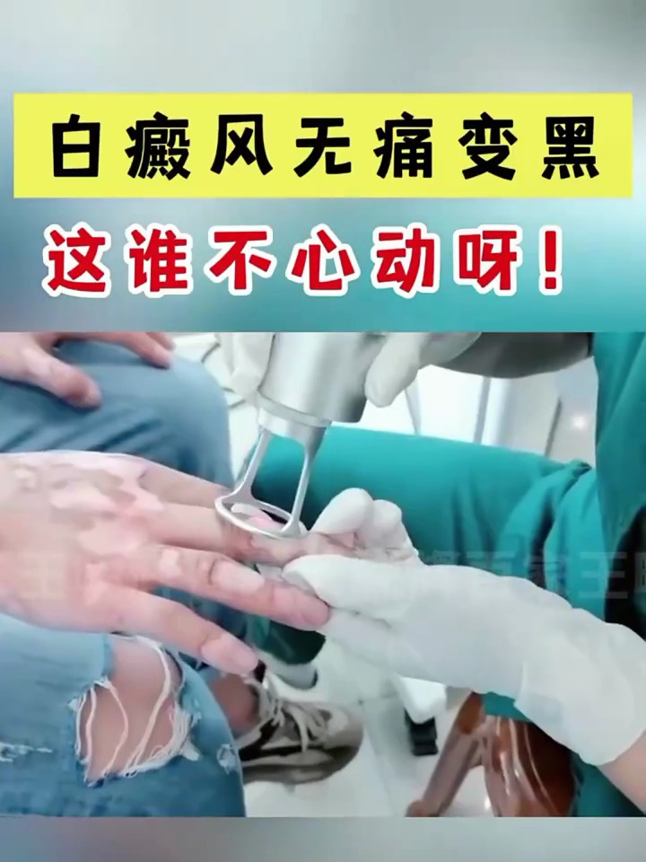 白癜风无痛变黑,这谁不心动!