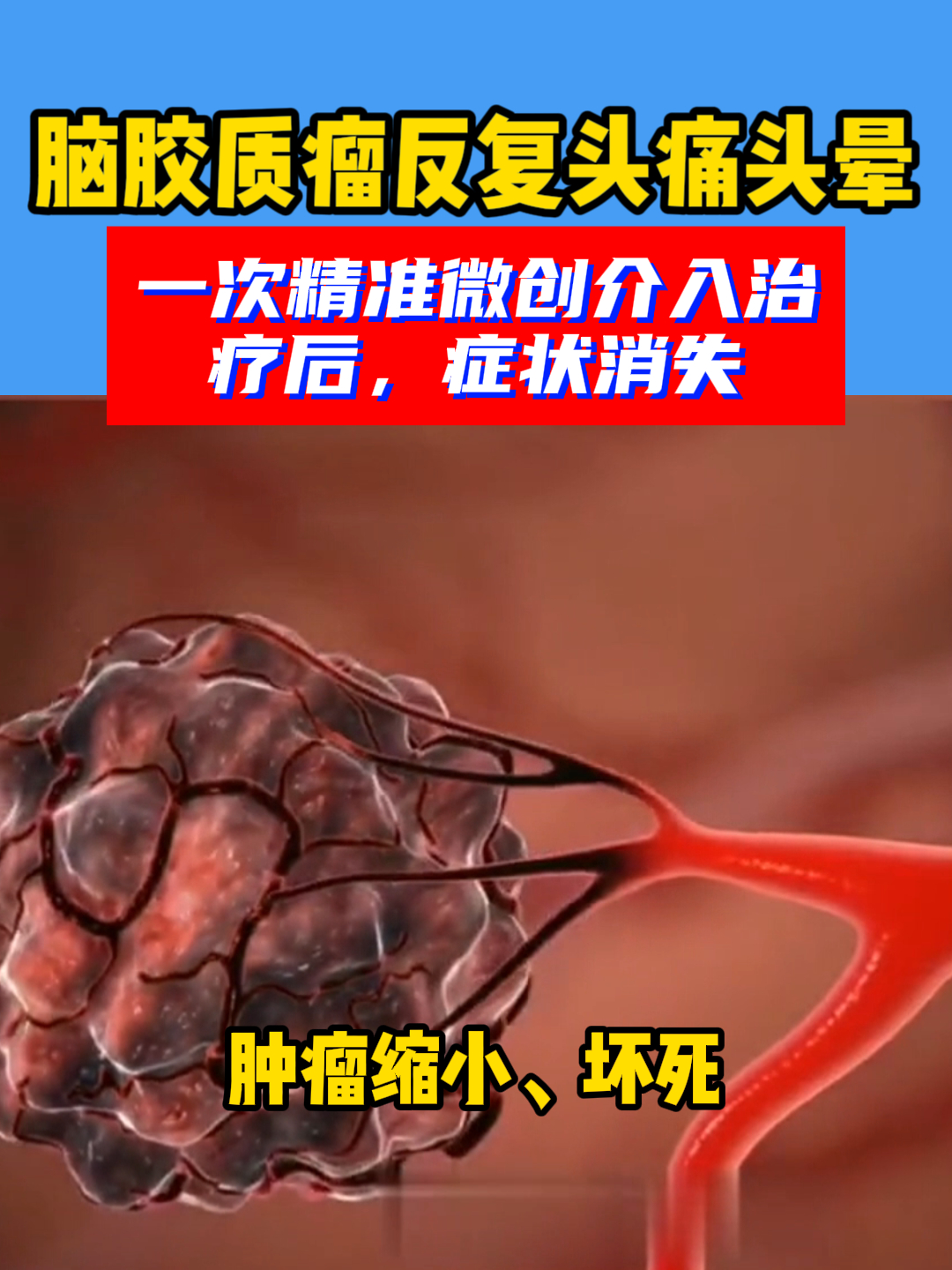 脑胶质瘤反复头痛头晕,一次微创介入治疗像健康人一样生活