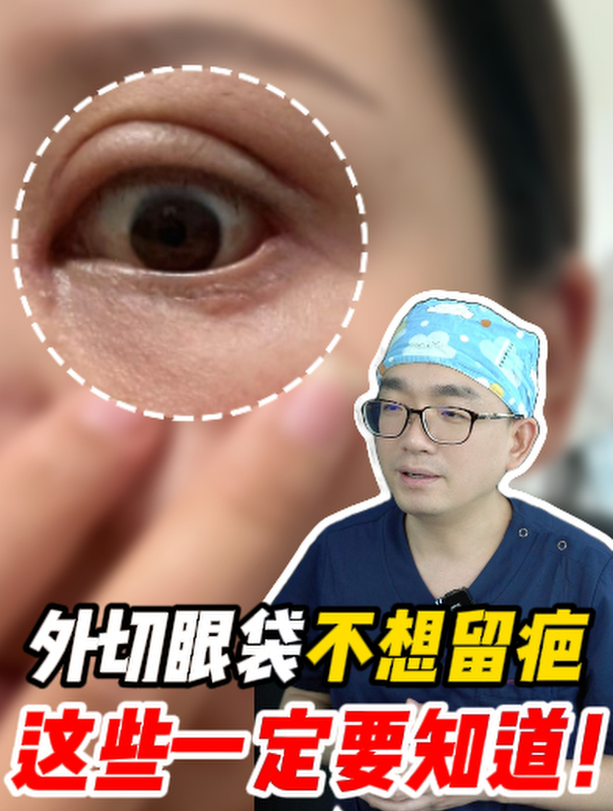 外切眼袋疤痕增生照片图片