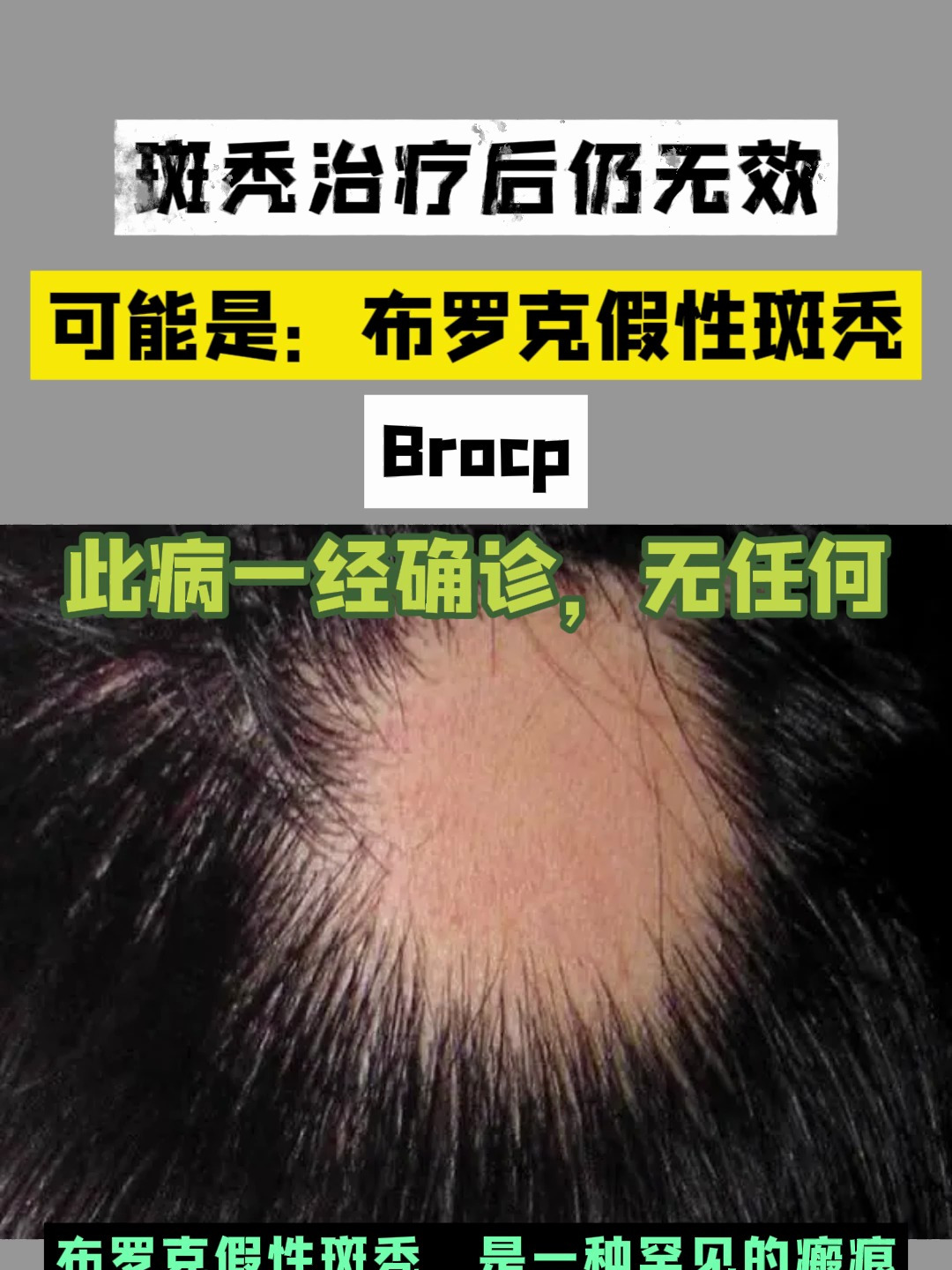 斑秃治疗无效可能是布罗克假性斑秃