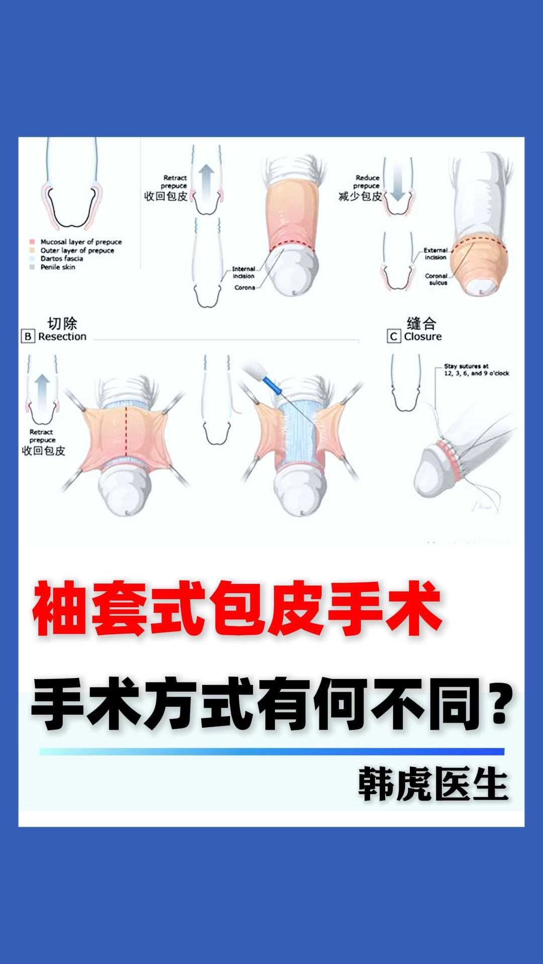 袖套式包皮手术,手术方式有何不同?