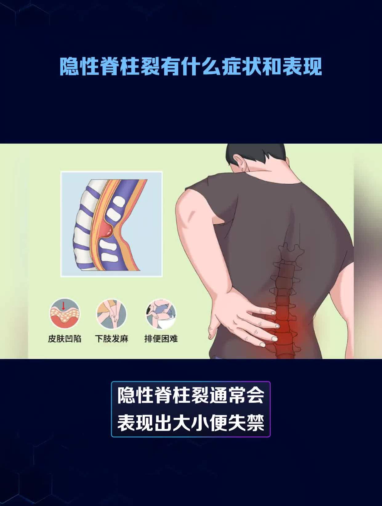 隐性脊柱裂有什么症状和表现