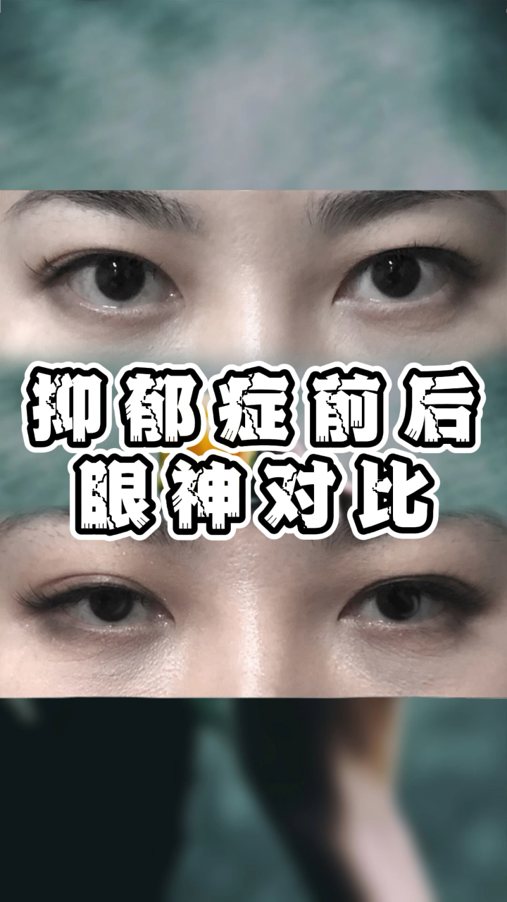 抑郁症前后眼神对比让人震惊大家可以去观察观察身边的人