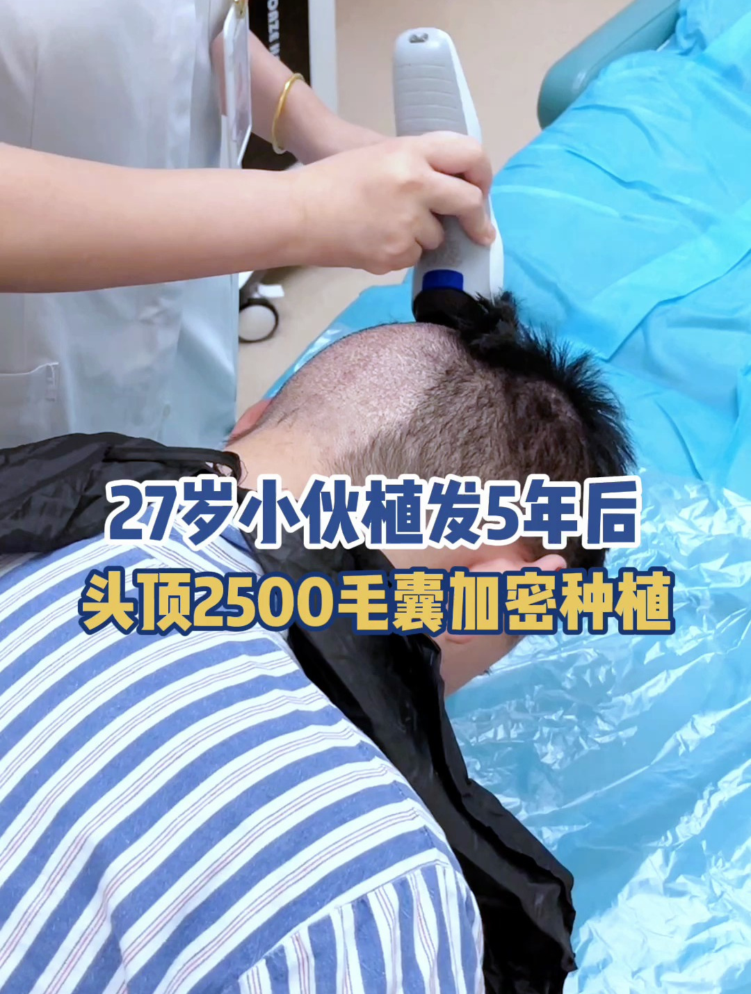 男植发感受(男性植发影响怀孕吗)
