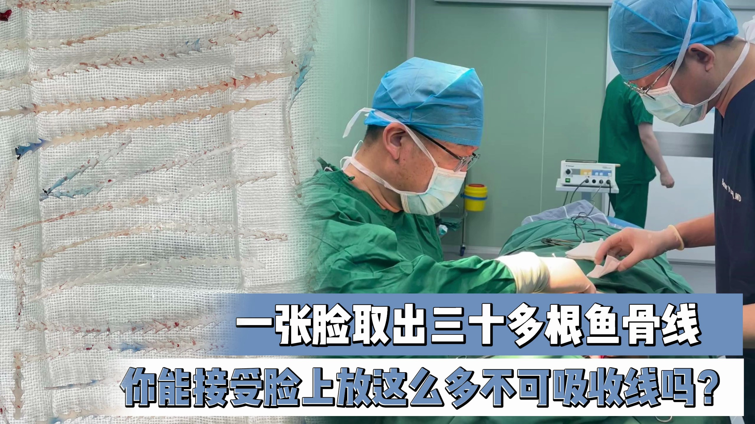 一张脸取出三十多根鱼骨线,你能接受脸上放这么多不可吸收线吗?
