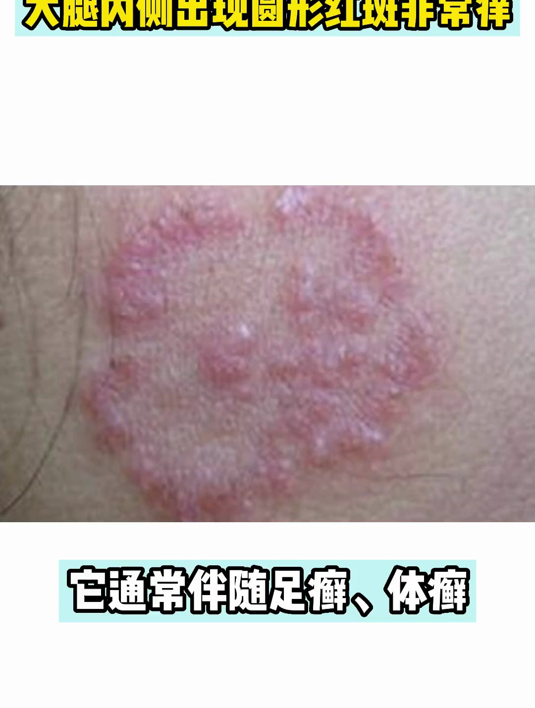 大腿内侧出现圆形红斑非常痒