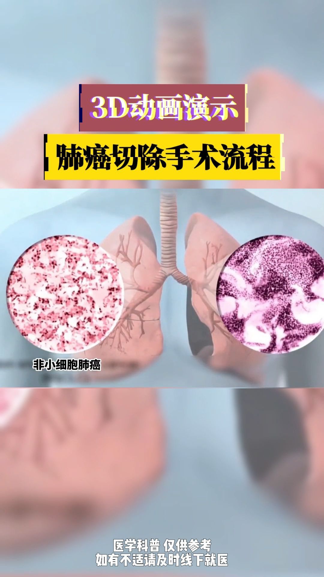 3d科普这就是治疗肺部肿瘤常见的手术