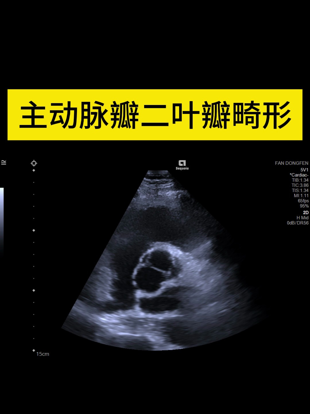 主动脉瓣上缩窄图片