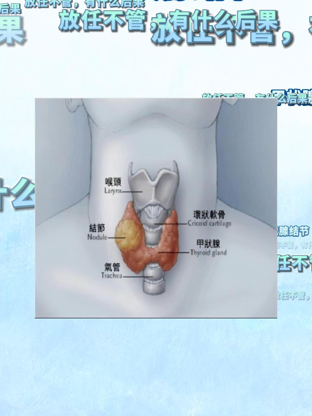 甲状腺结节会消失吗图片