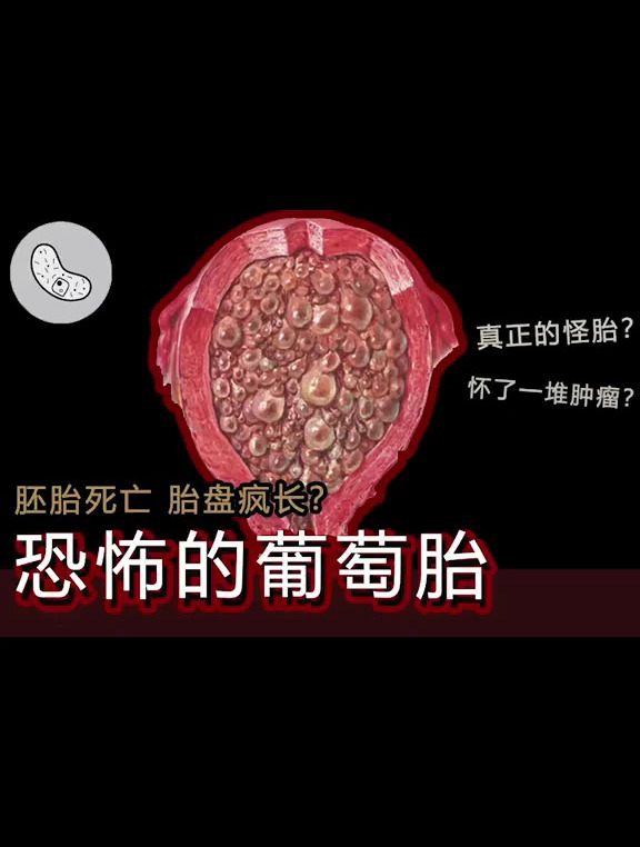 「恐怖的 葡萄胎」孩子死了把胎盘养大了?-度小视