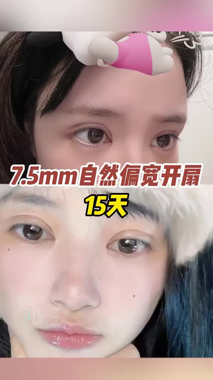 7.5mm自然偏宽开扇双眼皮